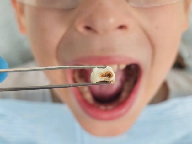 Best Emergency Treatment for Dental Infections or Abscesses in Belle Mead, NJ